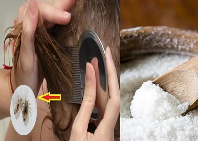 Làm Sao Để Hết Chấy Nhanh Nhất