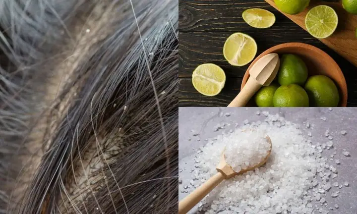 Làm Sao Để Hết Chấy Trên Đầu