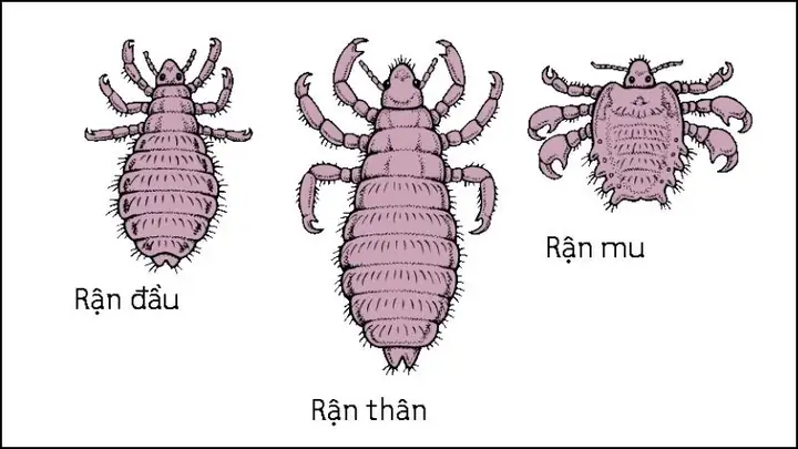Làm Sao Để Hết Chấy Trên Đầu