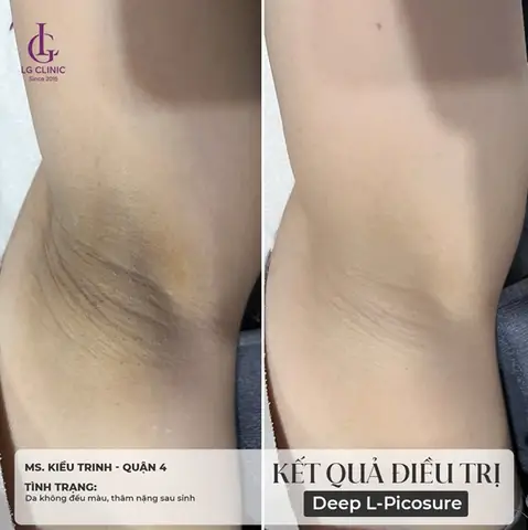 Làm Sao Để Trị Thâm Nách