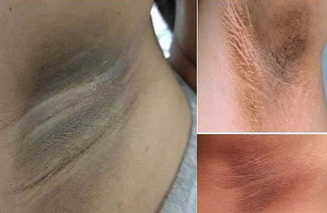 Làm Sao Để Trị Thâm Nách