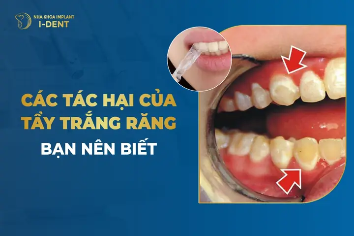 Làm Trắng Răng Cho Be 2 Tuổi