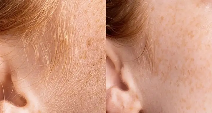 Lông Mặt Nhiều Có Nên Cạo Lông Mặt Nhiều Có Nên Cạo