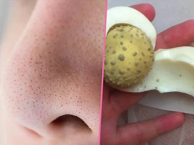 Lột Da Mặt Bằng Trứng Gà