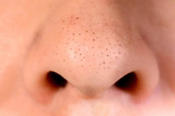 Lột Mụn Đầu Đen Ở Mũi Đúng Cách