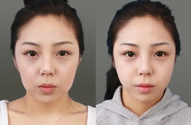 Mặt Bị Chảy Xệ Một Bên