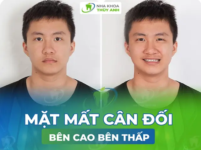 Mặt Bị Chảy Xệ Một Bên