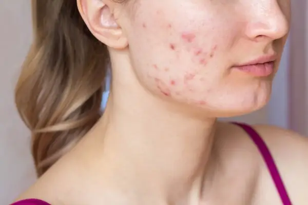 Mặt Nạ Giấy Trị Thâm Mụn Nhanh Nhất