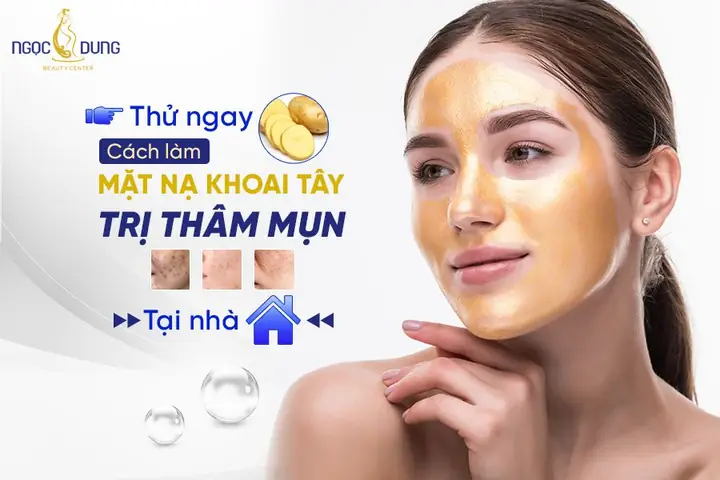 Mặt Nạ Khoai Tây Trị Thâm Mụn