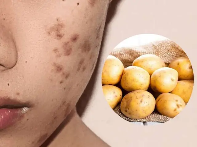 Mặt Nạ Khoai Tây Trị Thâm Mụn