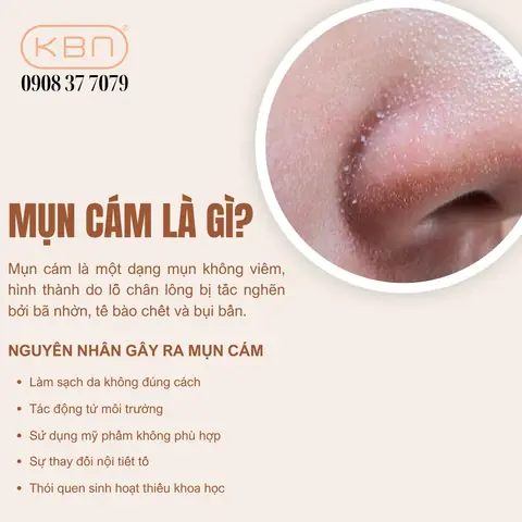 Mặt Nạ Làm Sạch Mụn Cám