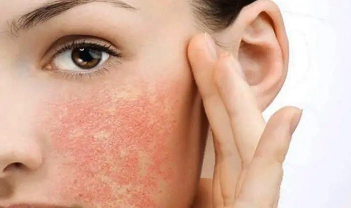 Mặt Nạ Phục Hồi Da Cháy Nắng Mặt Nạ Phục Hồi Da Cháy Nắng