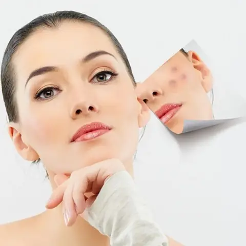 Mặt Nạ Sữa Chua Mật Ong Trị Mụn