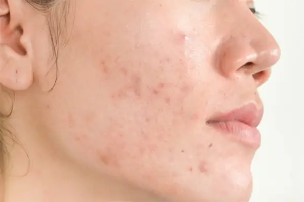 Mặt Nạ Trị Dị Ứng Mỹ Phẩm