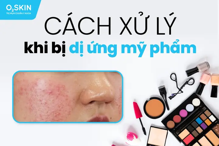Mặt Nạ Trị Dị Ứng Mỹ Phẩm