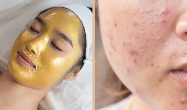 Mặt Nạ Trị Mụn Dành Cho Da Nhờn
