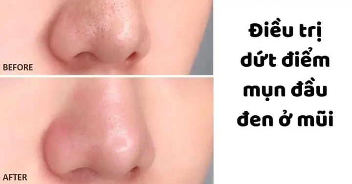 Mặt Nạ Trị Mụn Đầu Đen Ở Mũi