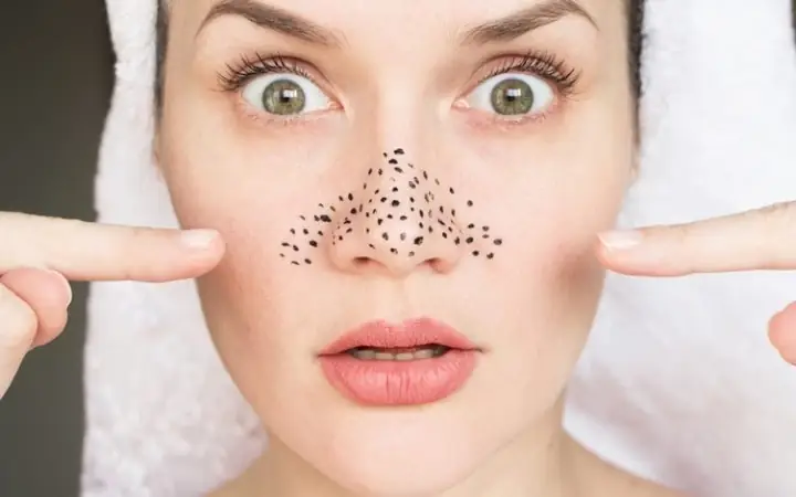 Mặt Nạ Trị Mụn Đầu Đen Tốt Nhất