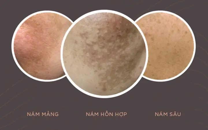 Mặt Nạ Trị Nám Không Bắt Nắng