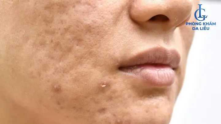 Mặt Nạ Trị Sẹo Rỗ Lâu Năm