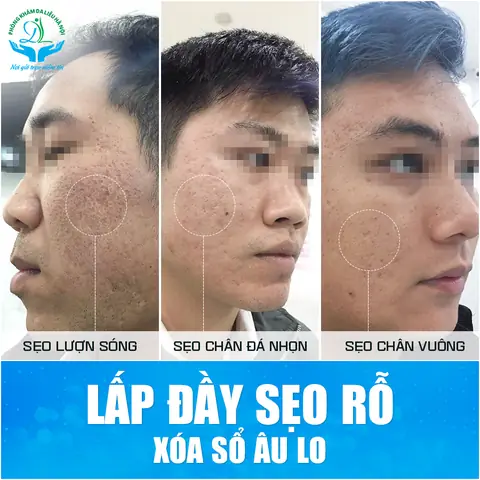 Mặt Nạ Trị Sẹo Rỗ Lâu Năm