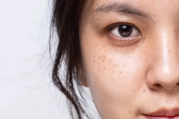 Mặt Nạ Trị Tàn Nhang Tự Nhiên