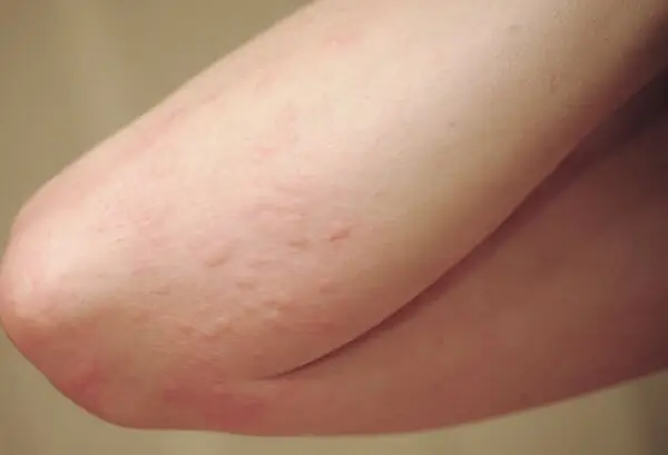 Mẹ Bầu Bị Mẩn Ngứa Ở Chân