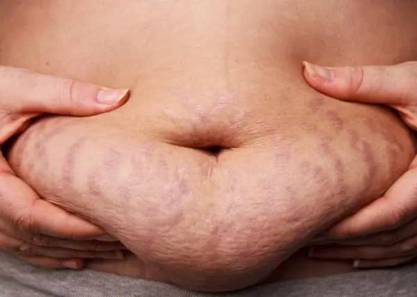 Mẹ Sau Sinh Bị Sổ Bụng