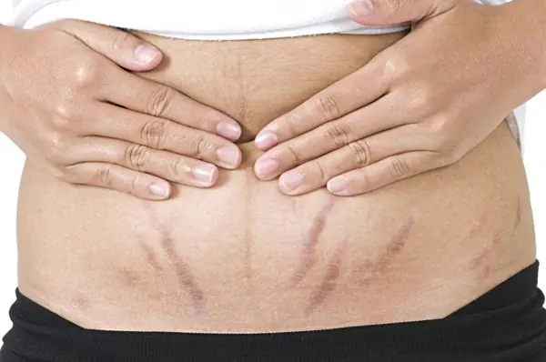 Mẹ Sau Sinh Bị Sổ Bụng