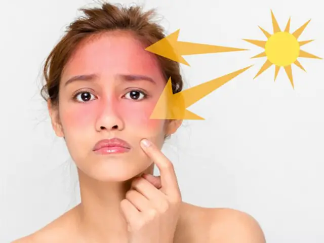 Mẹo Chữa Da Bị Cháy Nắng