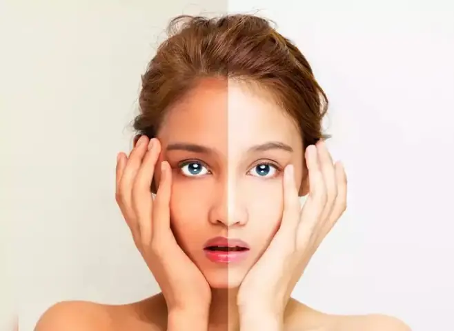 Mẹo Chữa Da Bị Cháy Nắng