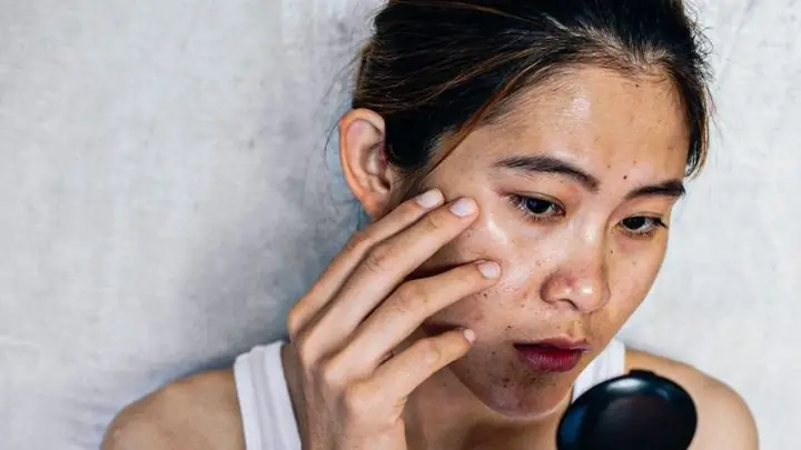 Mẹo Chữa Da Bị Cháy Nắng