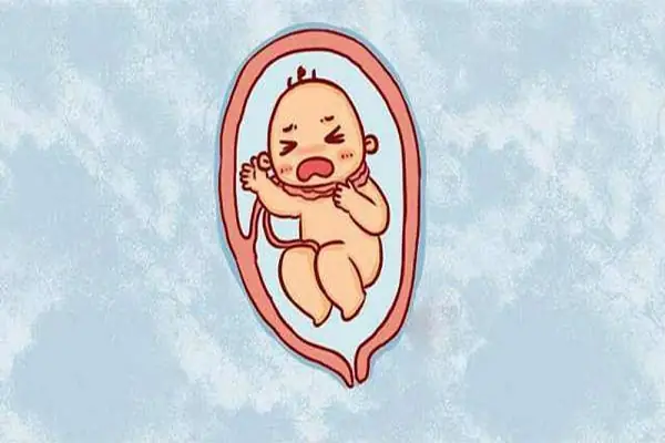 Mẹo Chữa Dây Rốn Quấn Cổ