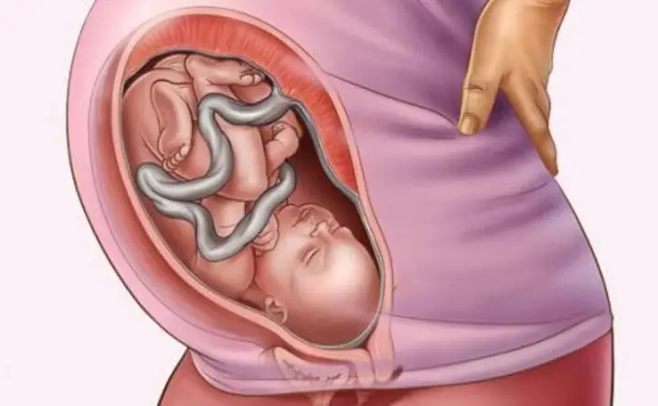 Mẹo Chữa Dây Rốn Quấn Cổ