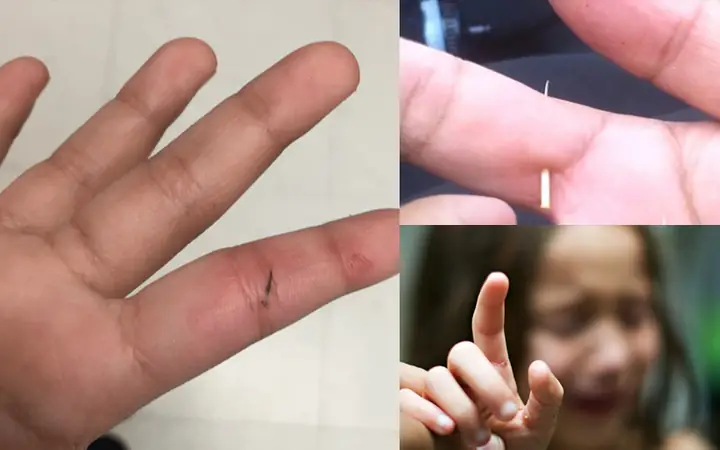 Mẹo Lấy Dằm Đâm Vào Tay