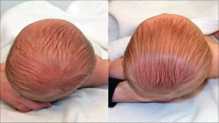 Mẹo Trị Méo Đầu Cho Trẻ Sơ Sinh