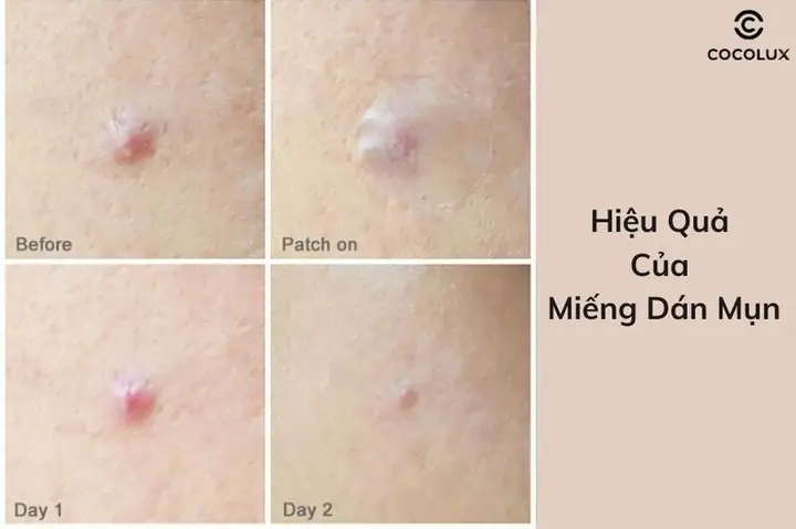Miếng Dán Mụn Có Tốt Không