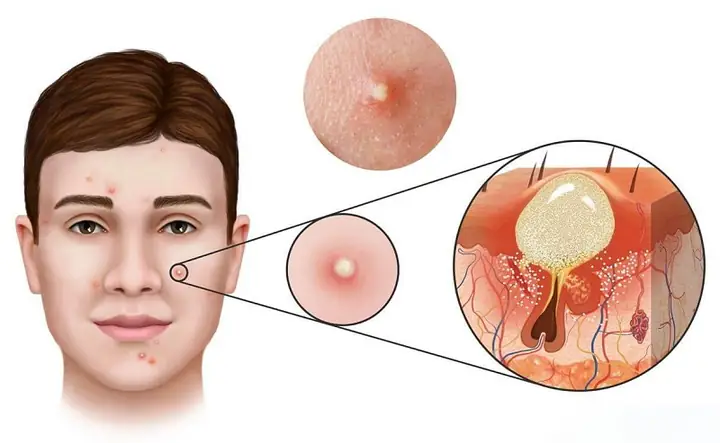 Miếng Dán Trị Mụn Có Tốt Không