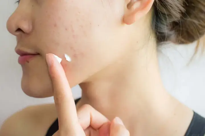 Mới Nặn Mụn Xong Có Nên Bôi Kem Chống Nắng