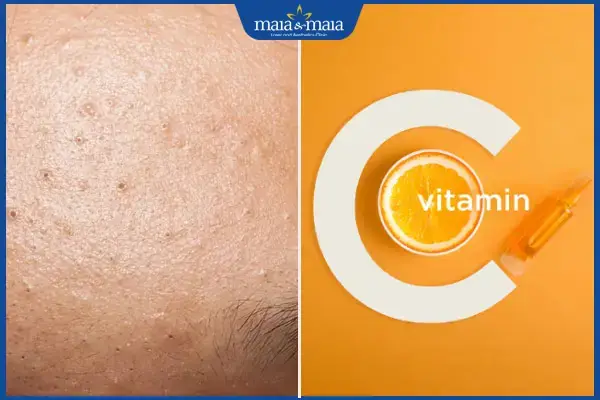Mụn An Có Nên Dùng Vitamin C
