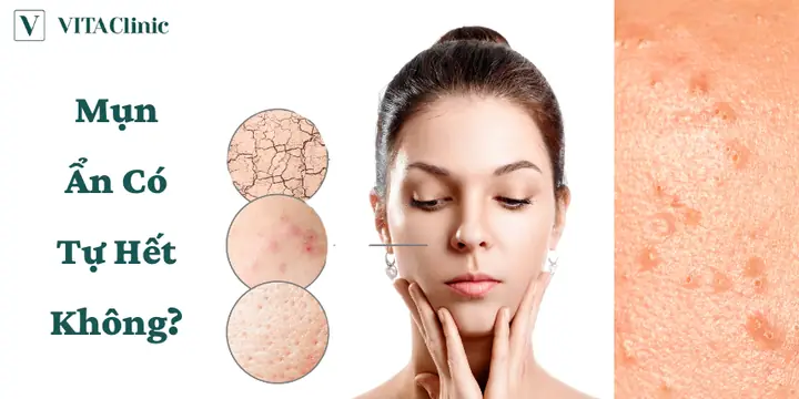 Mụn Ẩn Dưới Da Có Tự Hết Không