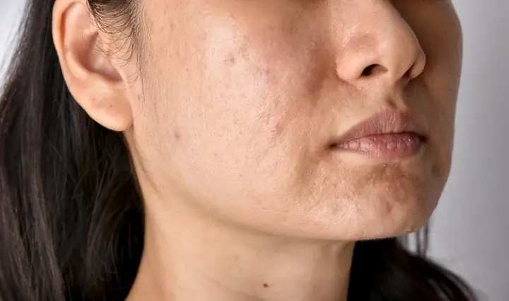 Mụn Ẩn Dưới Da Có Tự Hết Không