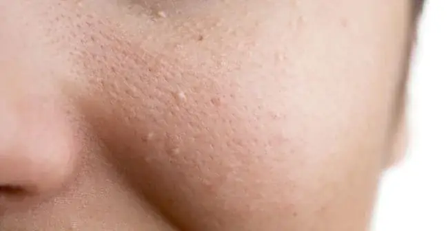 Mụn Ẩn Dưới Da Có Tự Hết Không