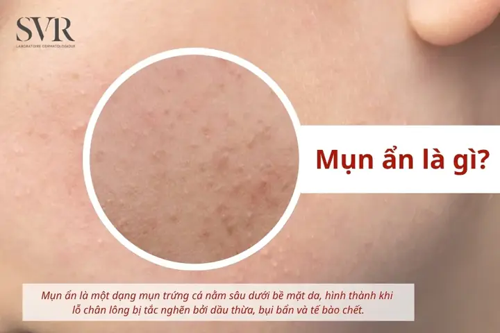 Mụn Ẩn Dưới Da Có Tự Hết Không