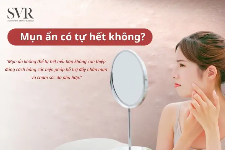 Mụn Ẩn Dưới Da Có Tự Hết Không