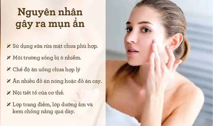 Mụn Ẩn Trồi Lên Có Nên Nặn Không