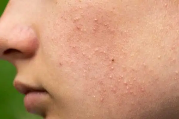 Mụn Ẩn Trồi Lên Có Nên Nặn Không