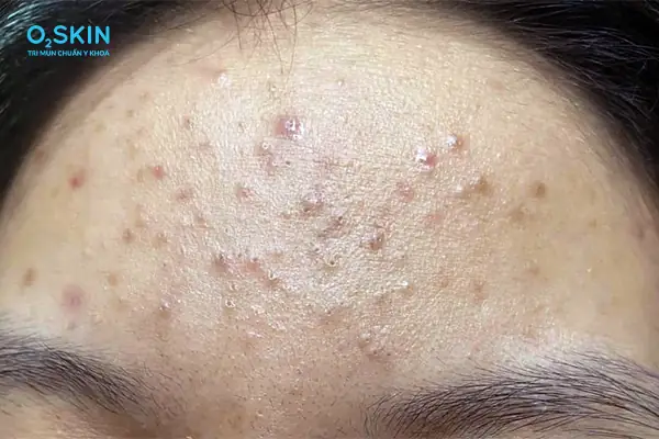 Mụn Ẩn Trồi Lên Có Nên Nặn Không