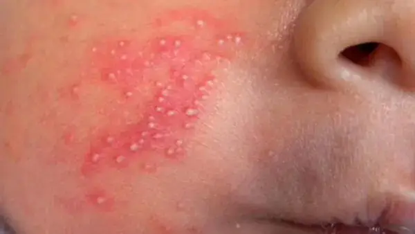Mụn Sữa Trắng Ở Trẻ Sơ Sinh