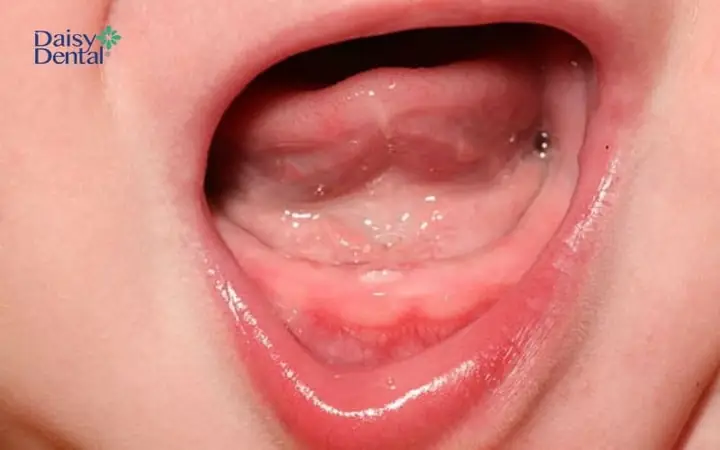 Mụn Sữa Trắng Ở Trẻ Sơ Sinh